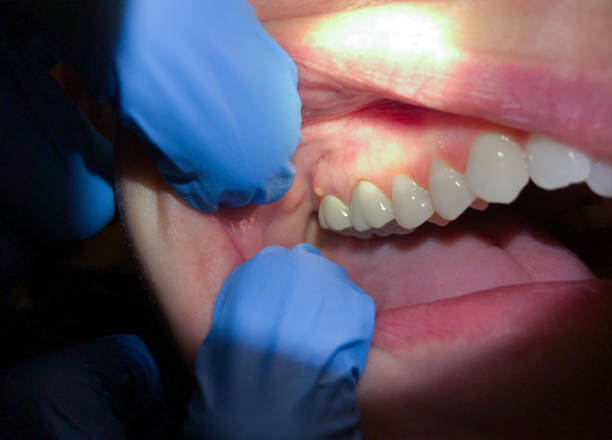 Best Urgent Tooth Repair  in Collinsville, AL